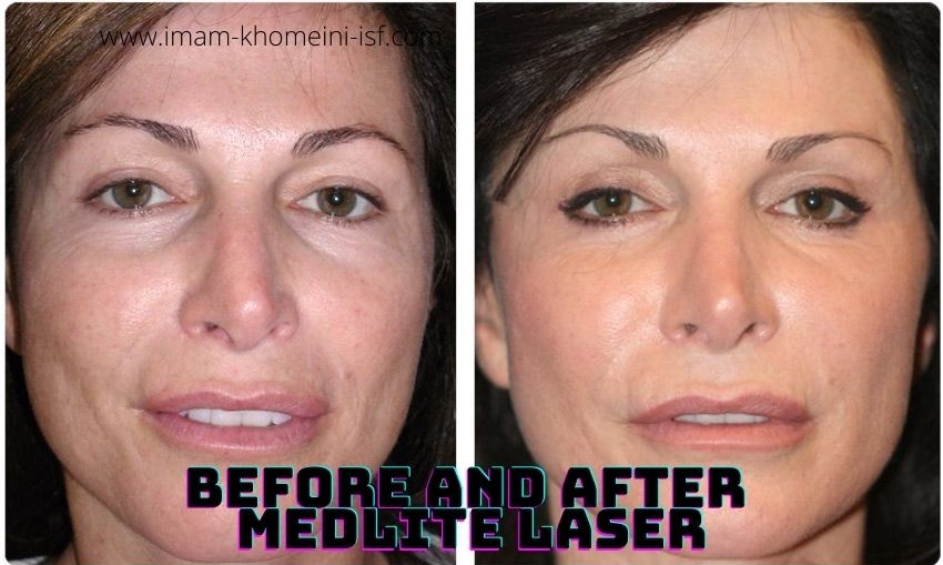 Before and After MedLite Laser