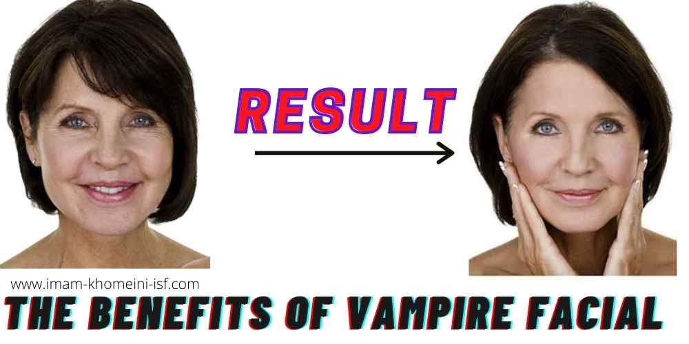 The benefits of Vampire Facial